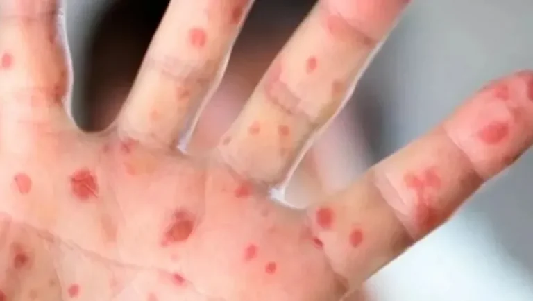 Aumentan casos de sarampión en México: Ssa