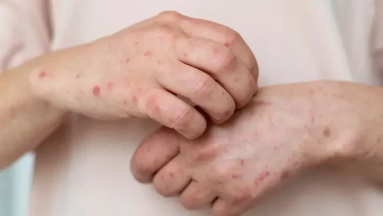 México suma 15 casos de viruela símica; cifra semanal más alta en lo que va del 2025