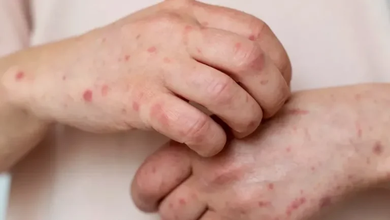 El sarampión representa una epidemia con amenaza creciente según especialista