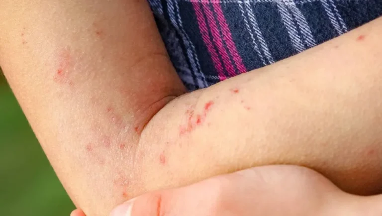 Detectan en Nuevo León tercer caso de viruela símica en 2025, registran un alza del 200%