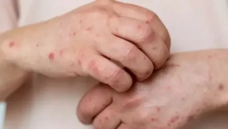 Primer caso confirmado de sarampión en NL: Secretaría de Salud implementa acciones para prevenir contagios