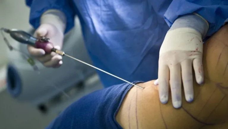 Tamaulipas: 2 de cada 10 pacientes de cirugía plástica son menores, advierten especialistas