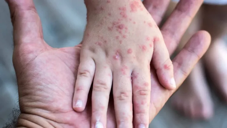 Confirman otro caso de sarampión en Nuevo León este 2026